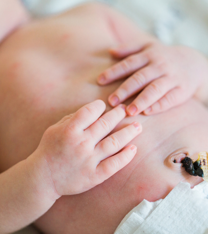 Newborn with Hernia Umbilical Cord - OAS