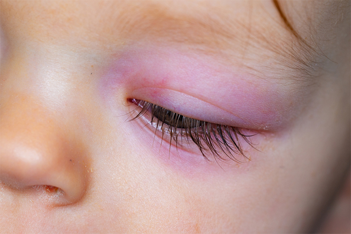 swollen-eye-in-babies-causes-treatment-and-home-remedies-baby-care