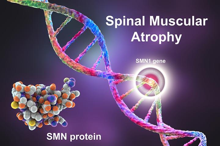 SMA (Spinal Muscular Atrophy) In Babies: Causes And Treatment