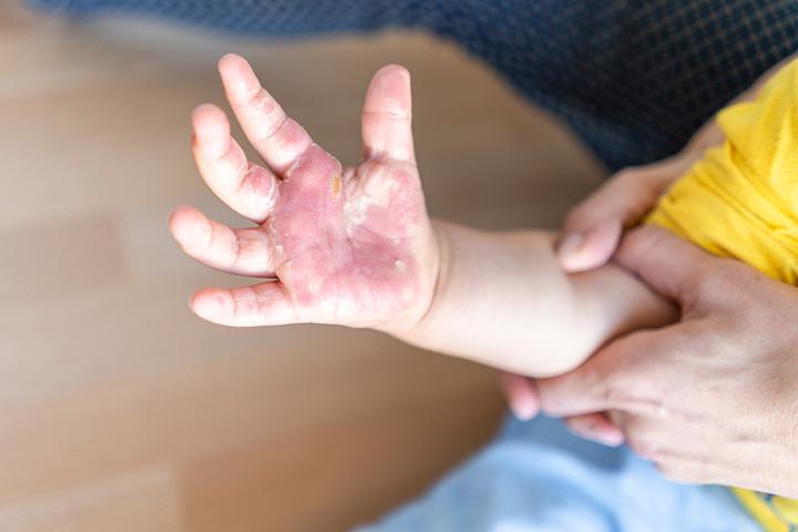 8 Treatment Options And Home Remedies For Burns In Children