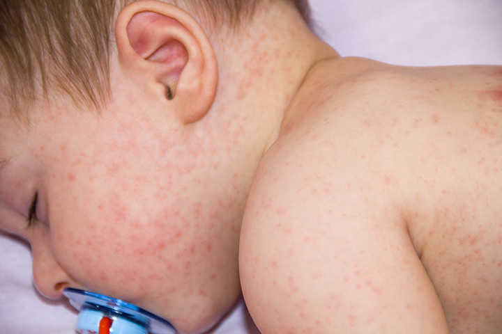 viral-rashes-in-babies-types-treatment-prevention-tips