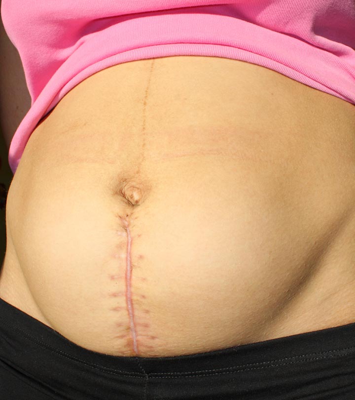How Many Stitches Are Required for a C-Section (Cesarean Birth