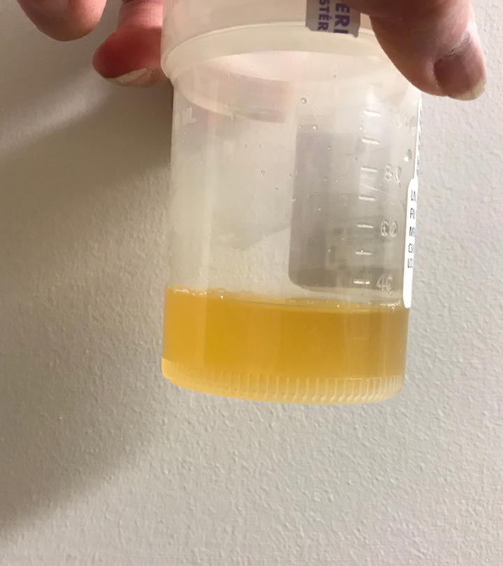 uti cloudy urine