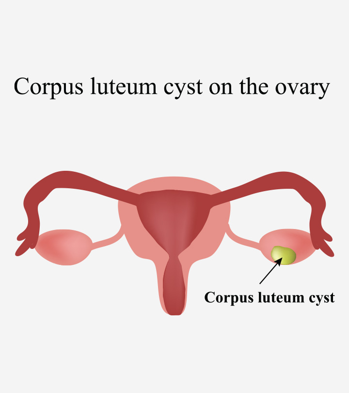 What is Corpus luteum? 