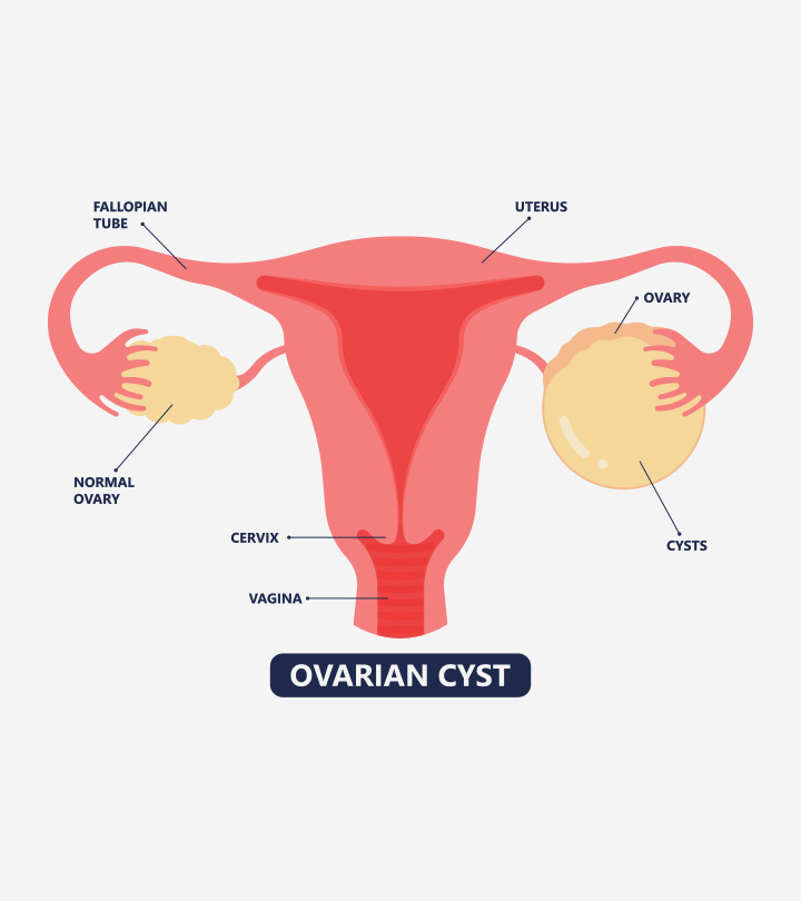 7 Common Symptoms Of Ovarian Cysts