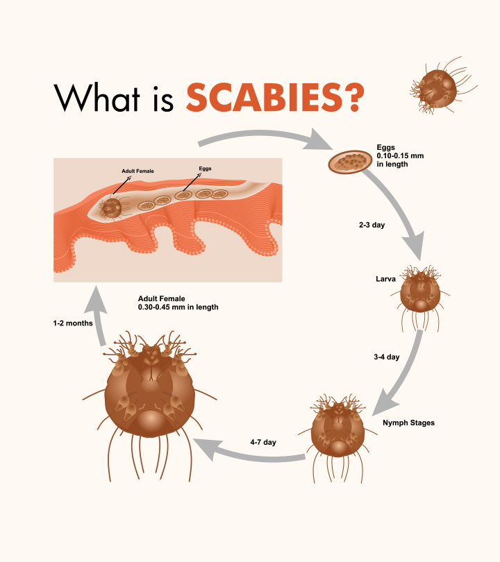 https://www.momjunction.com/wp-content/uploads/2021/10/Symptoms-Of-Scabies-In-Children-Treatment-And-Prevention.jpg