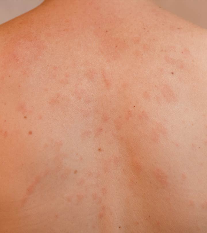 Pityriasis Rosea In Children Symptoms Causes And Treatment