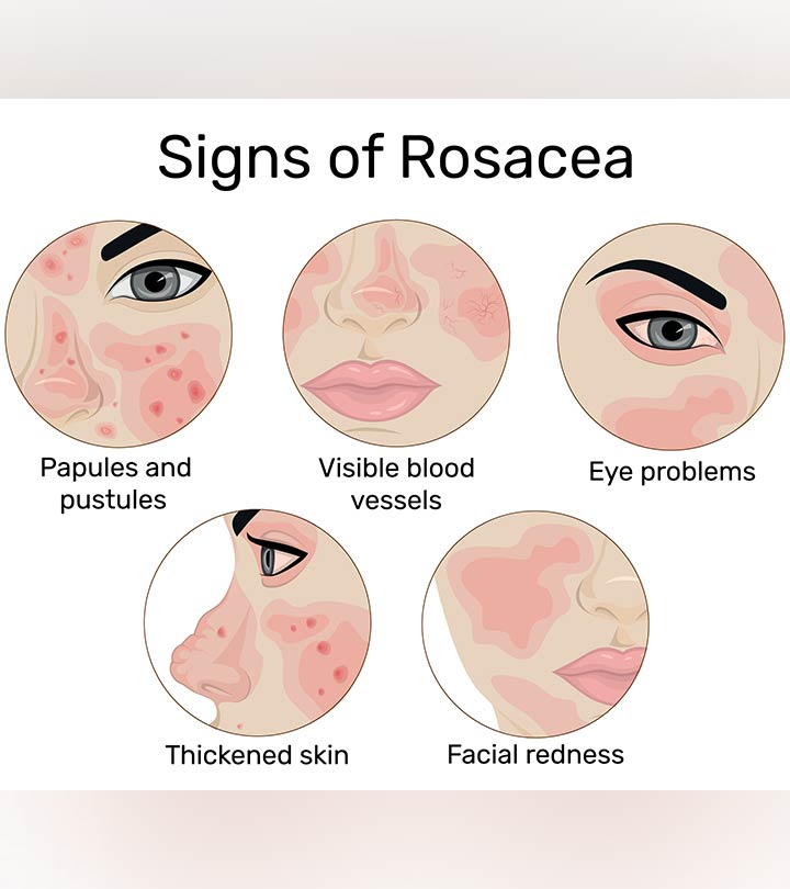 acne rosacea eyes