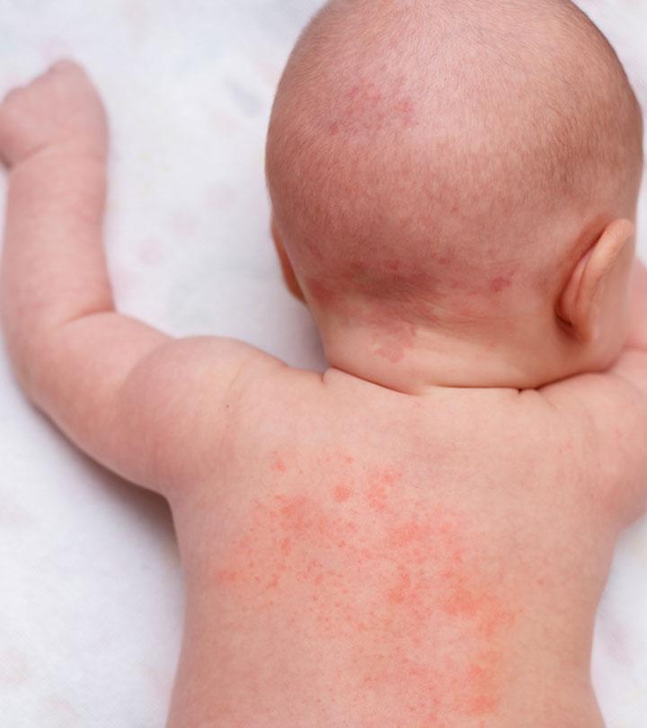 Baby Heat Rash Types Symptoms And Treatment