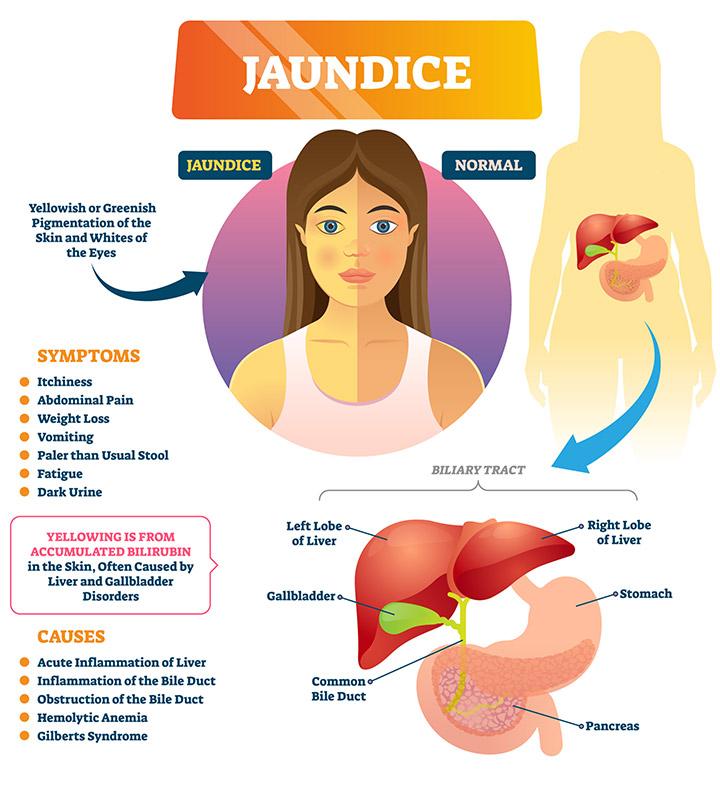 Jaundice In Children Types Causes Symptoms And Remedies