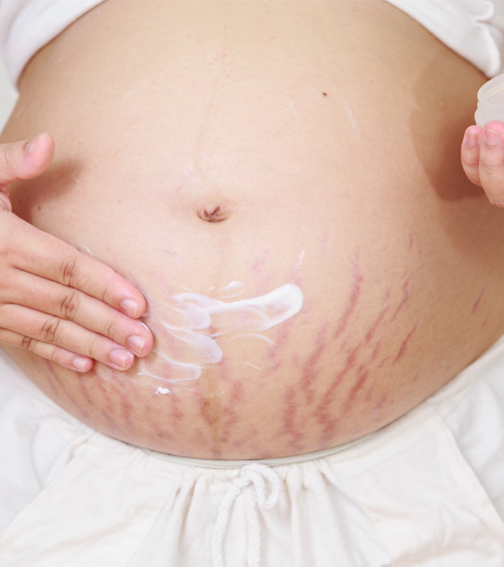 5 Effective Tips To Prevent Stretch Marks During Pregnancy Momjunction