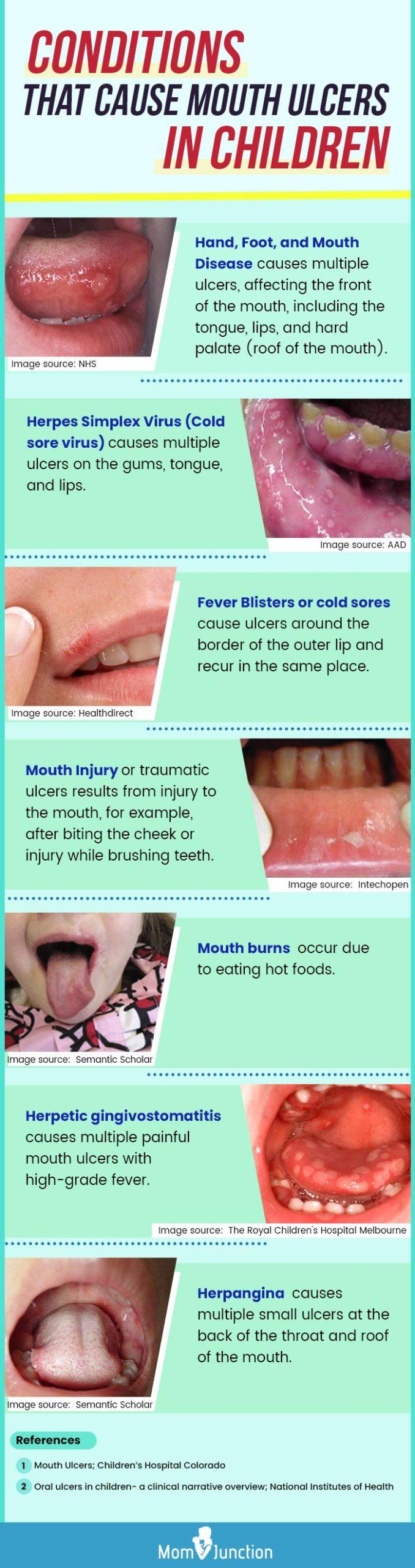 What Causes Mouth Ulcers And How To Treat Them Vrogue co