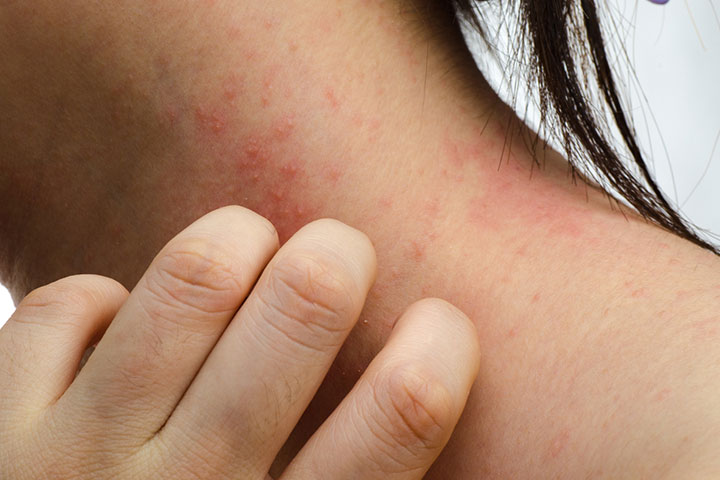 https://www.momjunction.com/wp-content/uploads/2022/10/Eczema-may-appear-like-yeast-infection.jpg