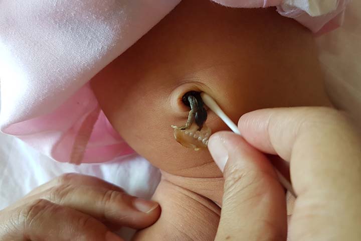 Umbilical Hernia in Babies & Children 