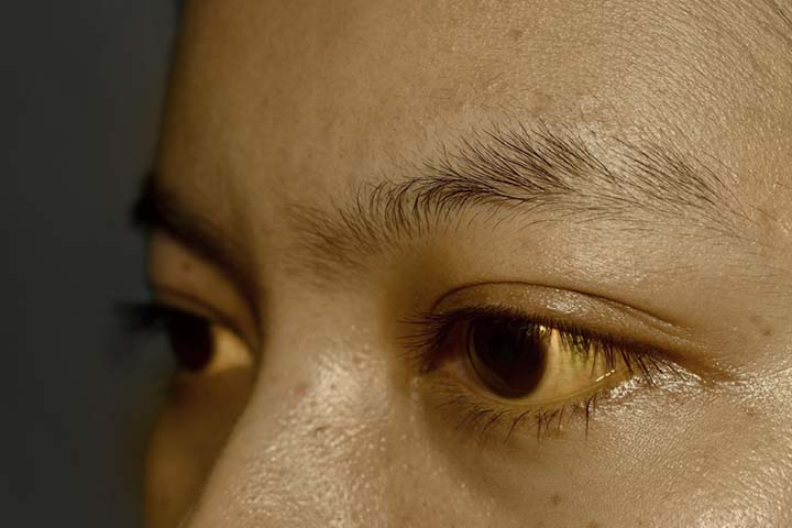 Yellow Skin (Jaundice): Pictures, Symptoms, Causes, and Diagnosis