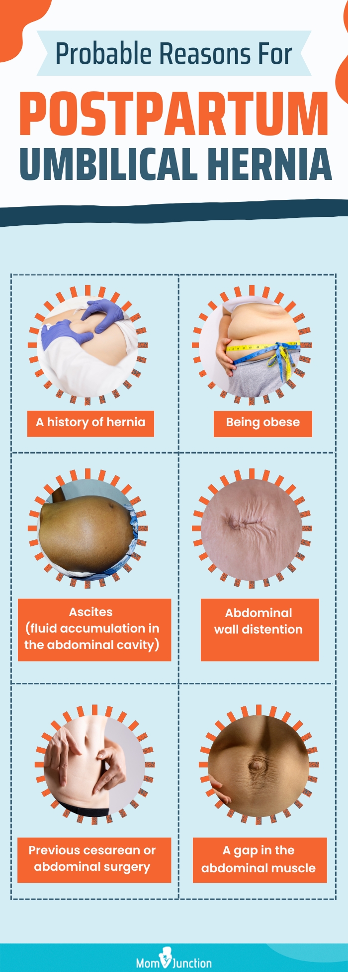 Signs and Symptoms of Umbilical Hernia