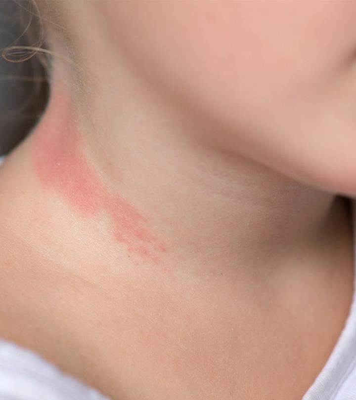 All You Need To Know About Baby Neck Rash