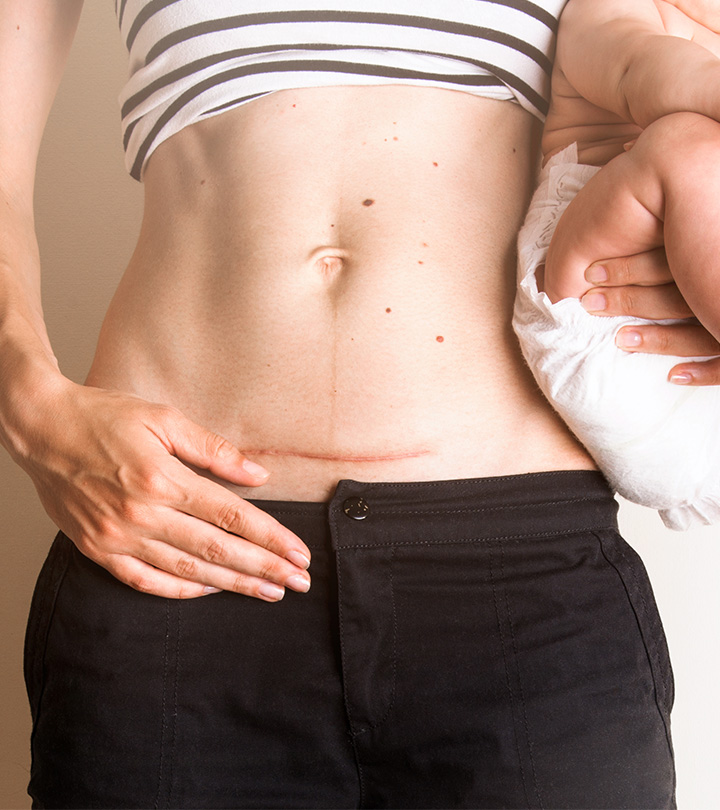 All You Need To Know About Caring For Your C-Section Scar